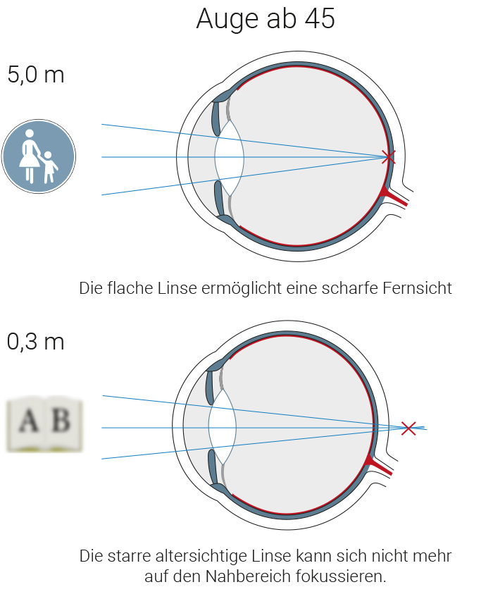 Ursachen der Altersweitsichtigkeit Die Ursache der Altersweitsichtigkeit verstehen