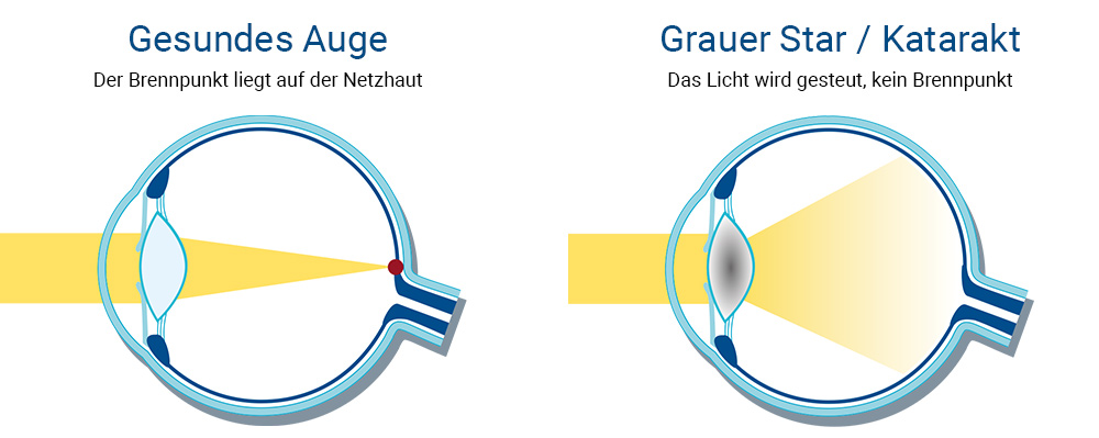 Grauer Star Erklärungsgrafik